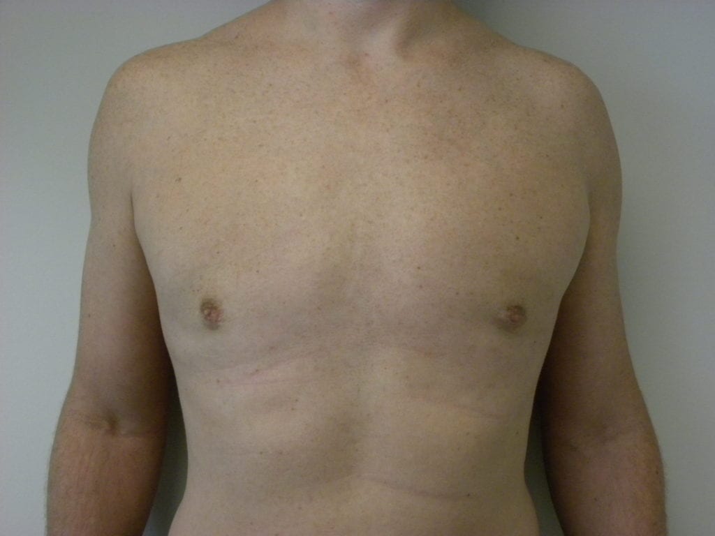 Gynecomastia Before and After Pictures Miami, FL