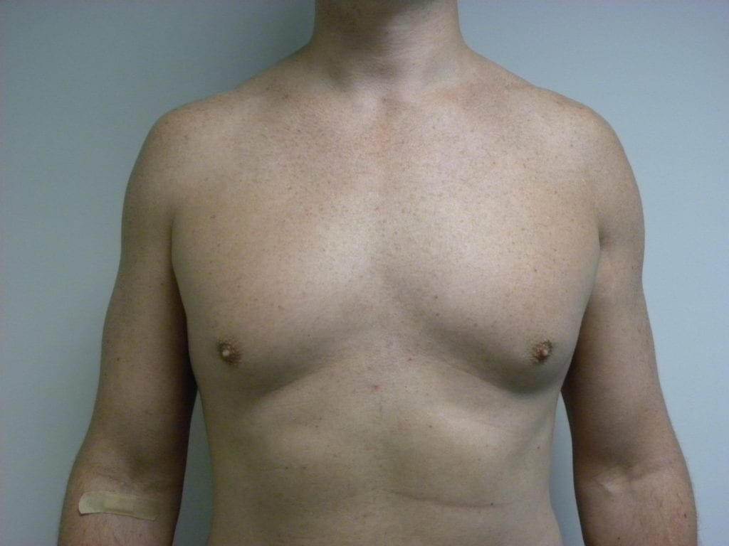 Gynecomastia Before and After Pictures Miami, FL