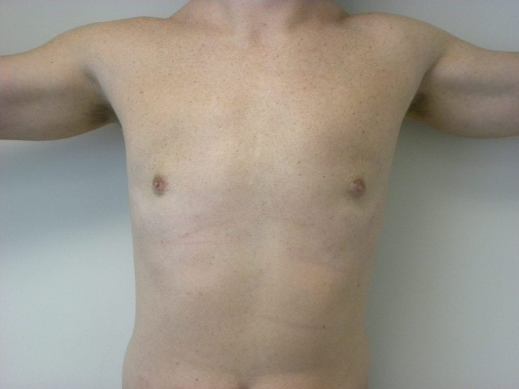 Gynecomastia Before and After Pictures Miami, FL