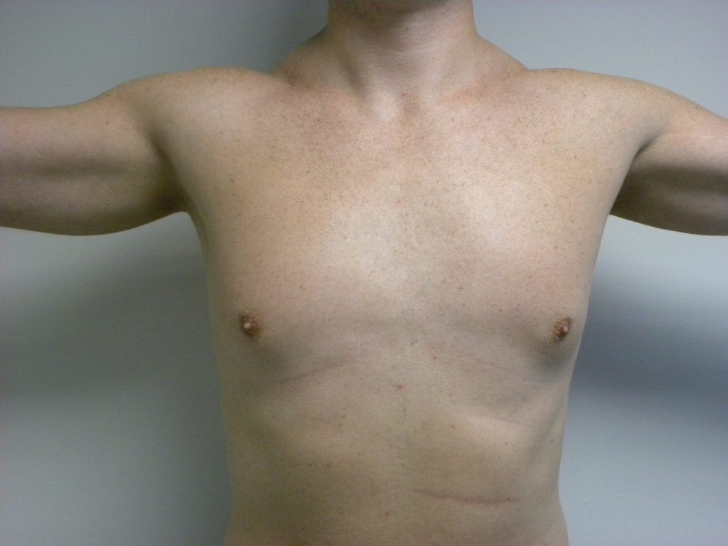 Gynecomastia Before and After Pictures Miami, FL