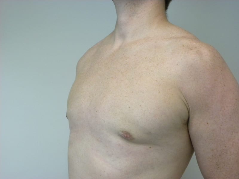 Gynecomastia Before and After Pictures Miami, FL