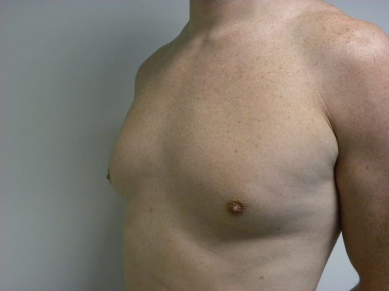 Gynecomastia Before and After Pictures Miami, FL