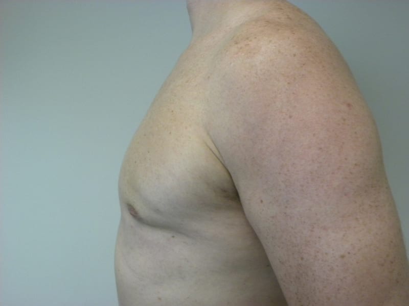 Gynecomastia Before and After Pictures Miami, FL