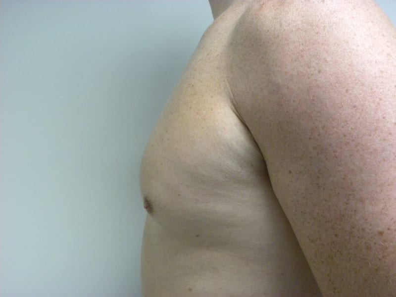 Gynecomastia Before and After Pictures Miami, FL