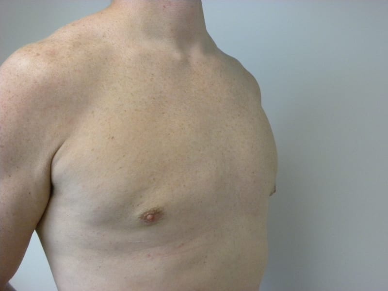 Gynecomastia Before and After Pictures Miami, FL