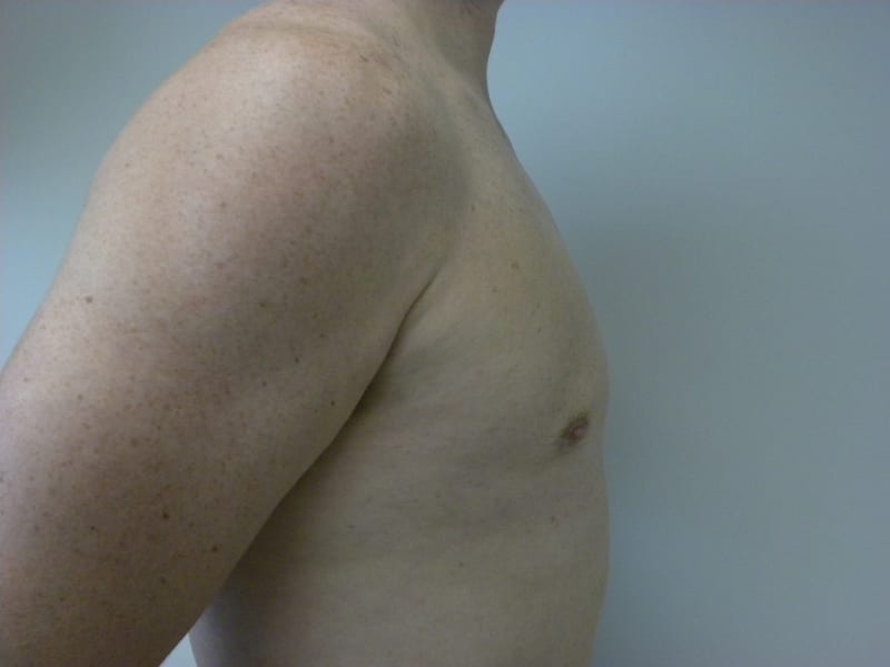 Gynecomastia Before and After Pictures Miami, FL