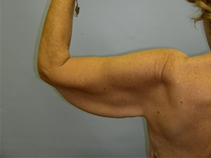 Arm Lift Before and After Pictures Miami, FL