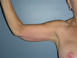 Arm Lift Before and After Pictures Miami, FL