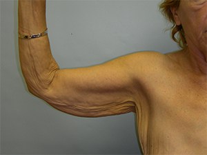 Arm Lift Before and After Pictures Miami, FL