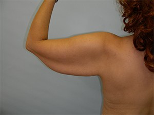 Arm Lift Before and After Pictures Miami, FL