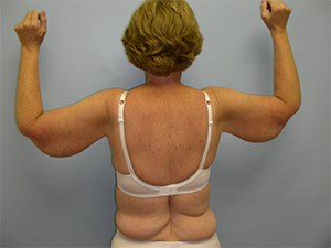 Arm Lift Before and After Pictures Miami, FL