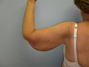 Arm Lift Before and After Pictures Miami, FL