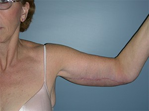 Plastic Surgery Before and After Pictures in Miami, FL - Dr. Adam J. Rubinstein 
