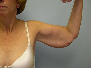 Arm Lift Before and After Pictures Miami, FL