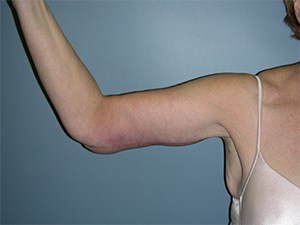 Arm Lift Before and After Pictures Miami, FL