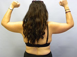 Arm Lift Before and After Pictures Miami, FL