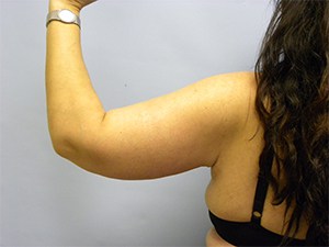 Arm Lift Before and After Pictures Miami, FL