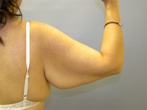 Arm Lift Before and After Pictures Miami, FL