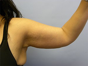 Arm Lift Before and After Pictures Miami, FL