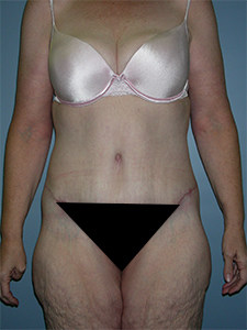 Body Lift Before and After Pictures Miami, FL