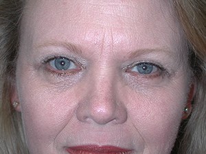 Blepharoplasty Before and After Pictures Miami, FL