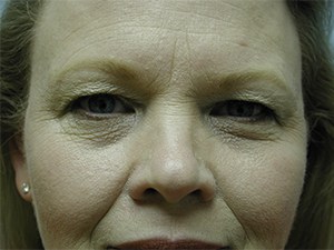 Blepharoplasty Before and After Pictures Miami, FL