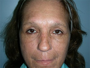 Blepharoplasty Before and After Pictures Miami, FL