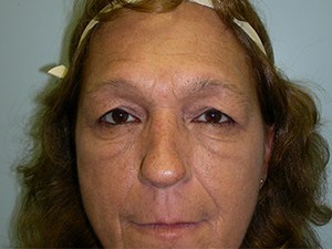 Blepharoplasty Before and After Pictures Miami, FL