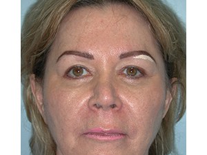 Blepharoplasty Before and After Pictures Miami, FL