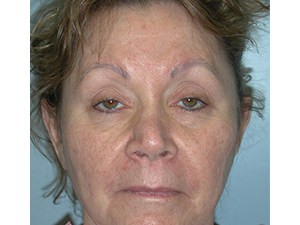 Blepharoplasty Before and After Pictures Miami, FL