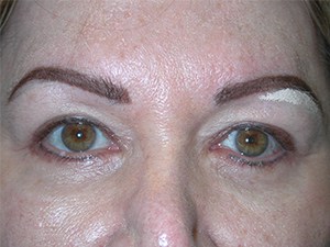 Blepharoplasty Before and After Pictures Miami, FL