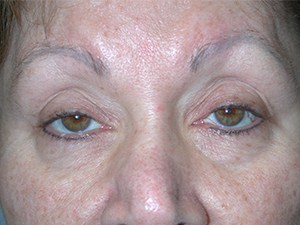 Blepharoplasty Before and After Pictures Miami, FL