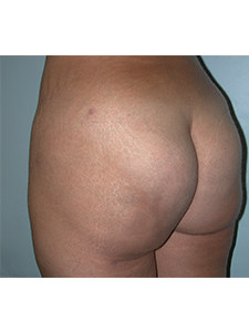 Brazilian Butt Lift Before and After Pictures Miami, FL