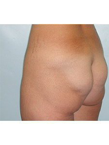 Brazilian Butt Lift Before and After Pictures Miami, FL