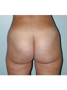 Brazilian Butt Lift Before and After Pictures Miami, FL