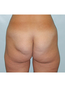 Brazilian Butt Lift Before and After Pictures Miami, FL