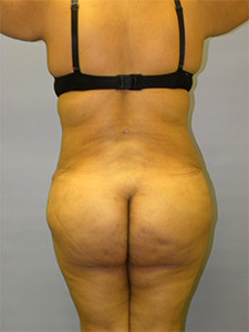 Brazilian Butt Lift Before and After Pictures Miami, FL