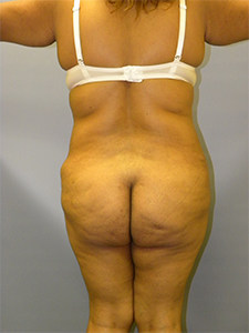 Brazilian Butt Lift Before and After Pictures Miami, FL