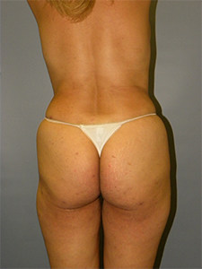 Brazilian Butt Lift Before and After Pictures Miami, FL