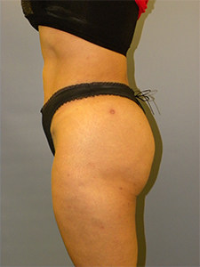 Brazilian Butt Lift Before and After Pictures Miami, FL