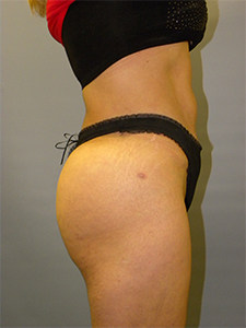 Brazilian Butt Lift Before and After Pictures Miami, FL