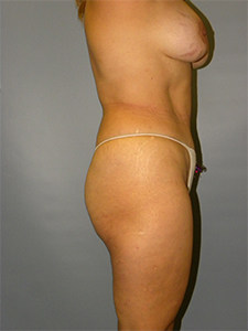 Brazilian Butt Lift Before and After Pictures Miami, FL