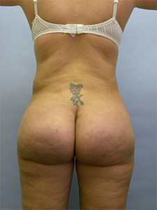 Brazilian Butt Lift Before and After Pictures Miami, FL