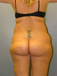 Brazilian Butt Lift Before and After Pictures Miami, FL