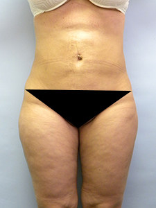 Brazilian Butt Lift Before and After Pictures Miami, FL