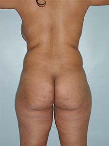 Brazilian Butt Lift Before and After Pictures Miami, FL