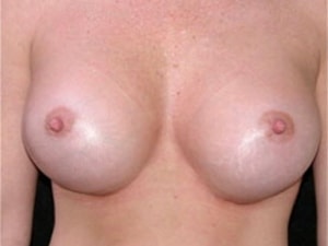 Breast Augmentation Before and After Pictures Miami, FL