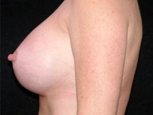 Breast Augmentation Before and After Pictures Miami, FL