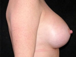 Breast Augmentation Before and After Pictures Miami, FL