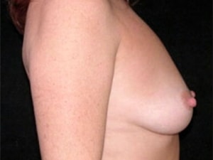 Breast Augmentation Before and After Pictures Miami, FL